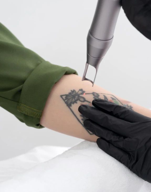 Tattoo verwijderen vanaf 120 euro