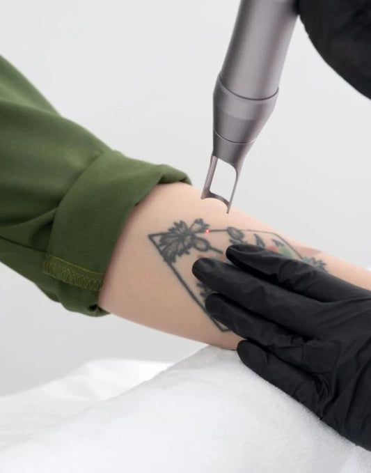 Tattoo verwijderen vanaf 120 euro